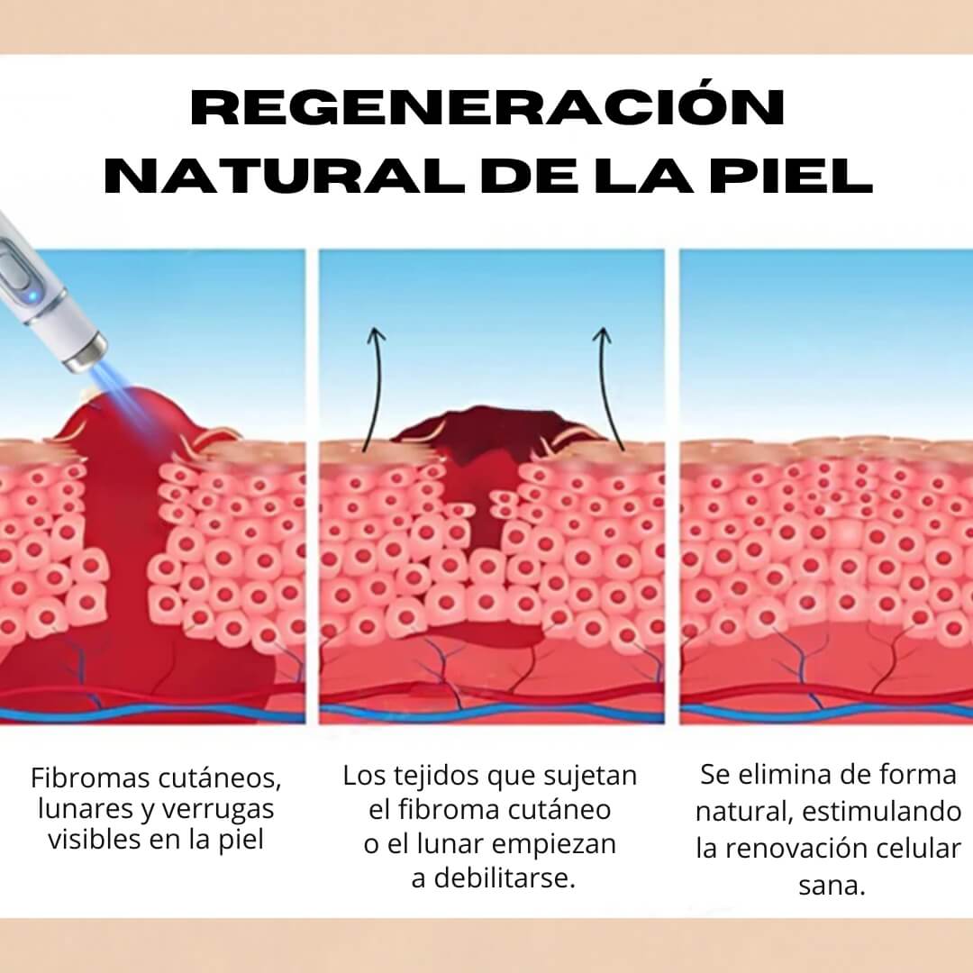 Kidsneed® – Bolígrafo láser para quitar lunares y verrugas